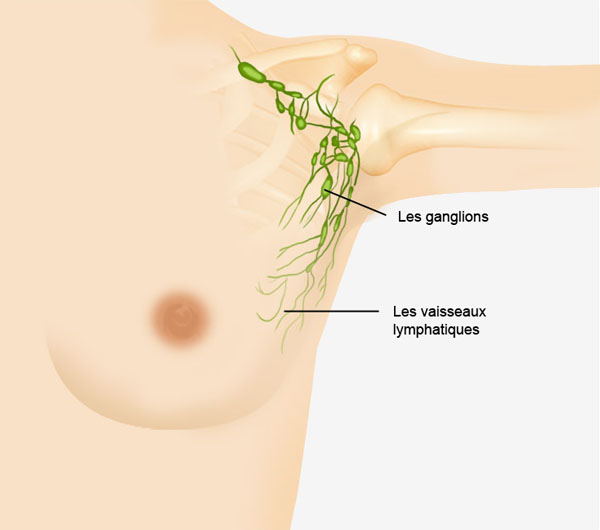 Le cancer du sein : traitement et chirurgie Dr Manciet à Sceaux