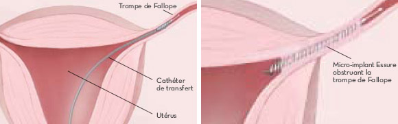 Schéma du positionnement implant méthode Essure